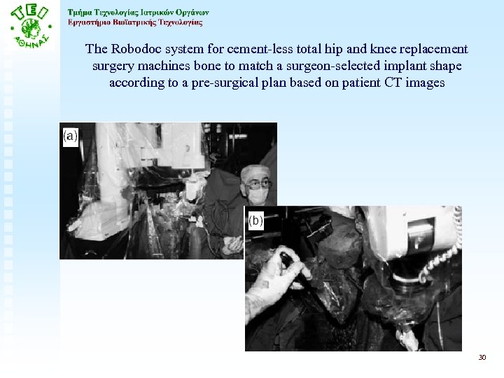 The Robodoc system for cement-less total hip and knee replacement surgery machines bone to