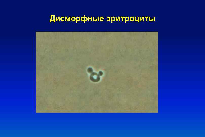 Дисморфные эритроциты 