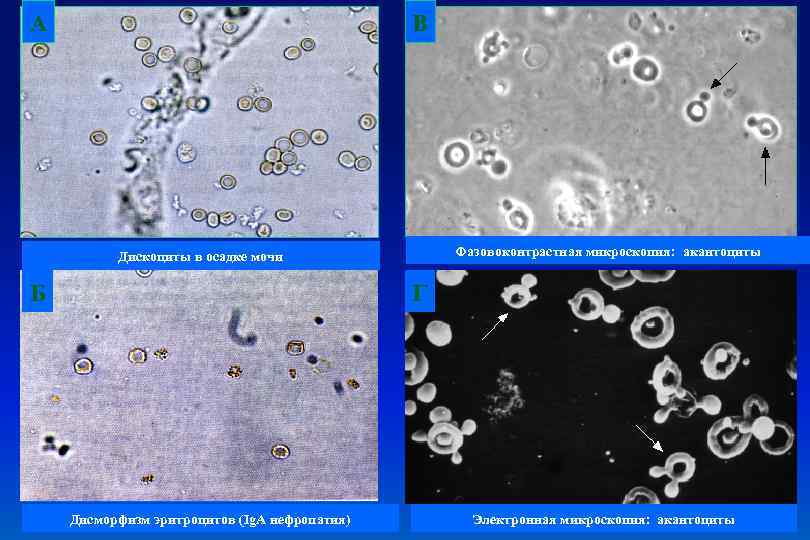 А В Фазовоконтрастная микроскопия: акантоциты Дискоциты в осадке мочи Б Г Дисморфизм эритроцитов (Ig.