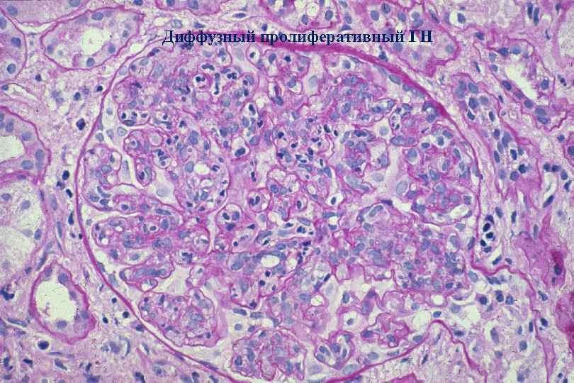 Диффузный пролиферативный ГН 