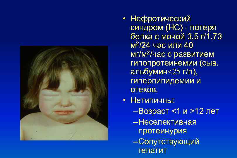  • Нефротический синдром (НС) - потеря белка с мочой 3, 5 г/1, 73