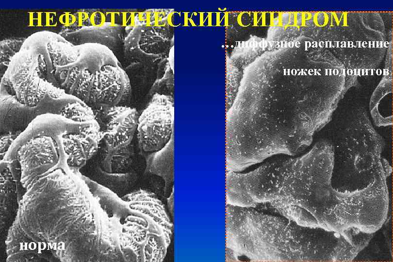 НЕФРОТИЧЕСКИЙ СИНДРОМ …диффузное расплавление ножек подоцитов норма 