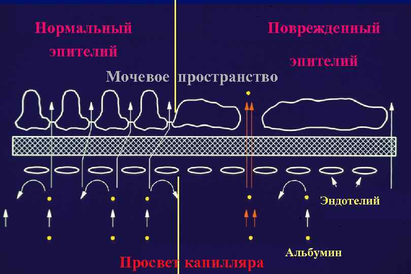 Нормальный эпителий Поврежденный Мочевое пространство эпителий Эндотелий Просвет капилляра Альбумин 