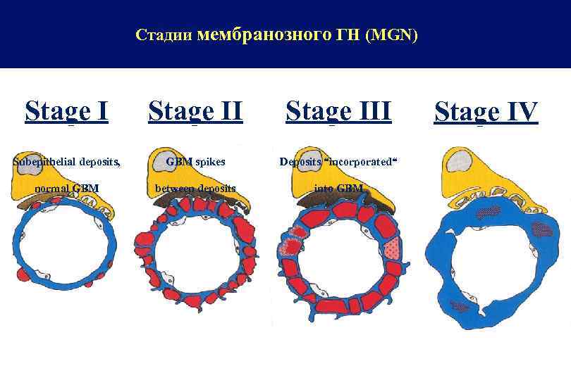 Стадии мембранозного ГН (MGN) Stage III Stage IV Subepithelial deposits, GBM spikes Deposits “incorporated“