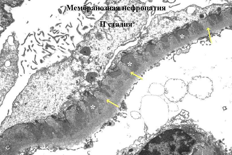 Мембранозная нефропатия II стадия * * * 