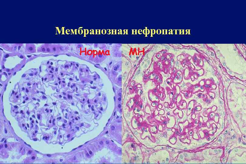 Мембранозная нефропатия Норма МН 