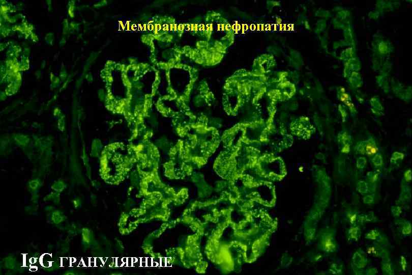 Мембранозная нефропатия Ig. G ГРАНУЛЯРНЫЕ 