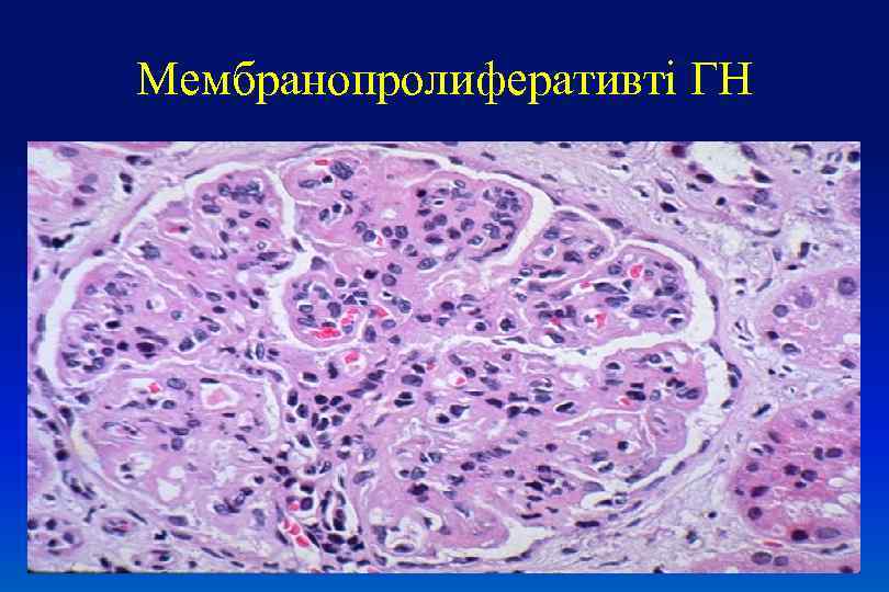 Мембранопролиферативті ГН 