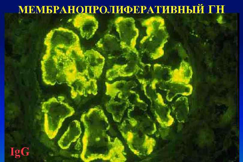 МЕМБРАНОПРОЛИФЕРАТИВНЫЙ ГН Ig. G 