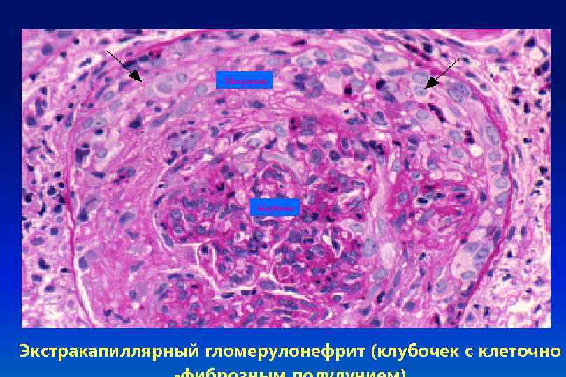 Полулуние Клубочек Экстракапиллярный гломерулонефрит (клубочек с клеточно 