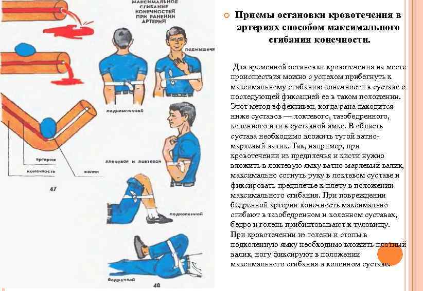  Приемы остановки кровотечения в артериях способом максимального сгибания конечности. Для временной остановки кровотечения