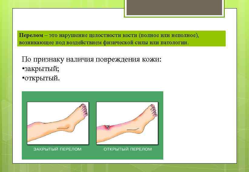 Перелом – это нарушение целостности кости (полное или неполное), возникающее под воздействием физической силы