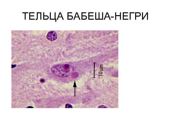 ТЕЛЬЦА БАБЕША НЕГРИ 