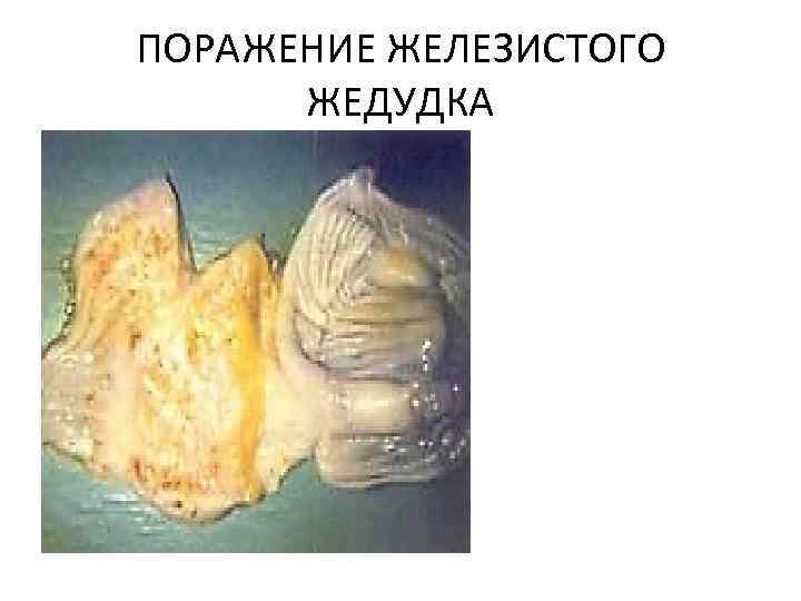 ПОРАЖЕНИЕ ЖЕЛЕЗИСТОГО ЖЕДУДКА 