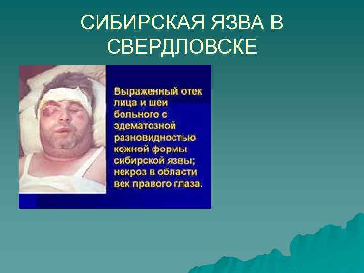 СИБИРСКАЯ ЯЗВА В СВЕРДЛОВСКЕ 