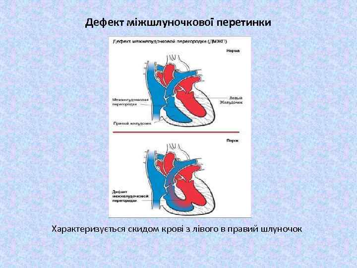 Дефект міжшлуночкової перетинки Характеризується скидом крові з лівого в правий шлуночок 