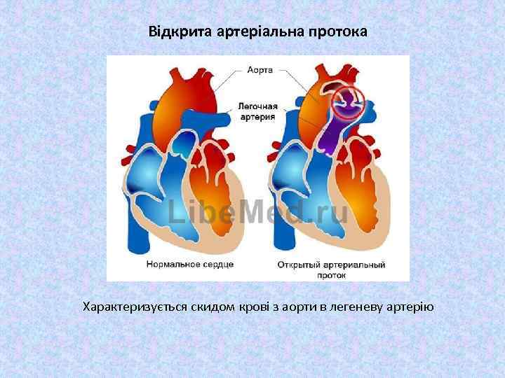 Відкрита артеріальна протока Характеризується скидом крові з аорти в легеневу артерію 