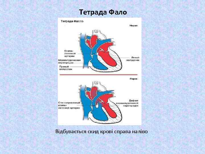 Тетрада фалло лечение