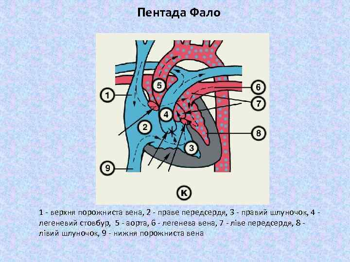 Пентада Фало 1 - верхня порожниста вена, 2 - праве передсердя, 3 - правий