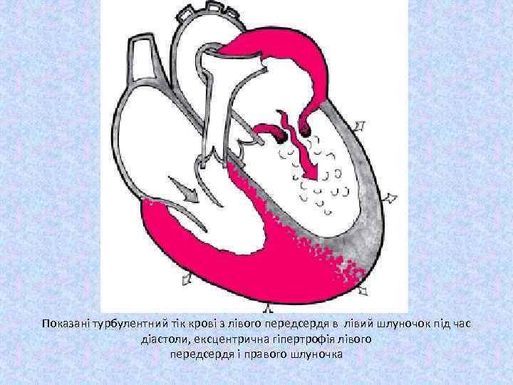 Показані турбулентний тік крові з лівого передсердя в лівий шлуночок під час діастоли, ексцентрична