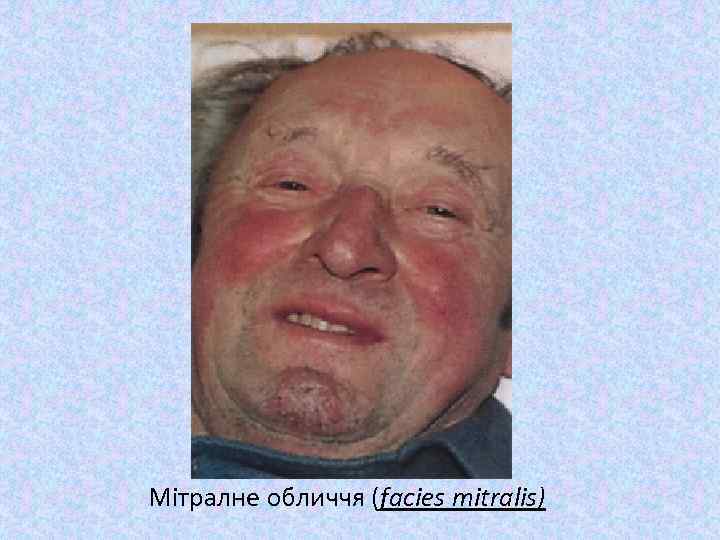 Мітралне обличчя (facies mitralis) 