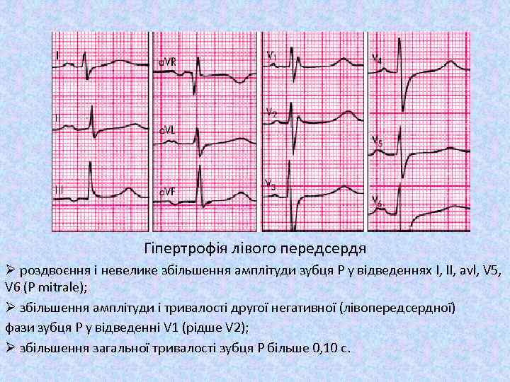 Гіпертрофія лівого передсердя Ø роздвоєння і невелике збільшення амплітуди зубця Р у відведеннях I,