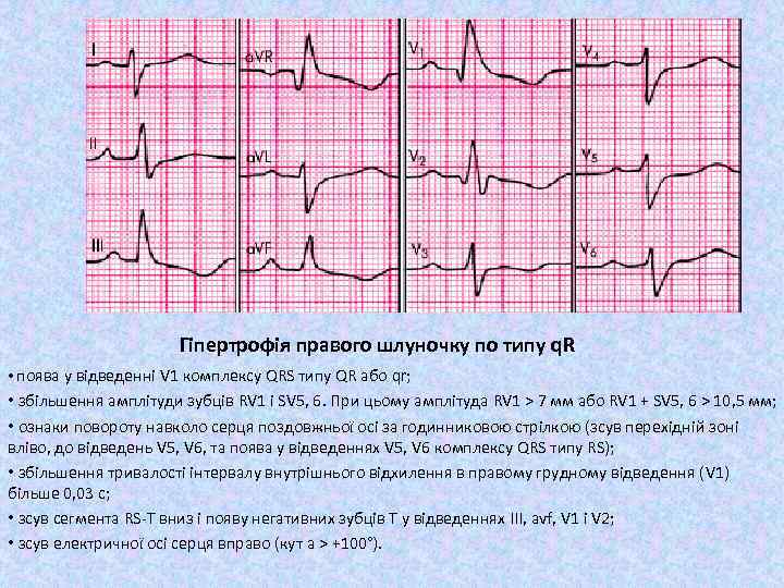 Гіпертрофія правого шлуночку по типу q. R • поява у відведенні V 1 комплексу