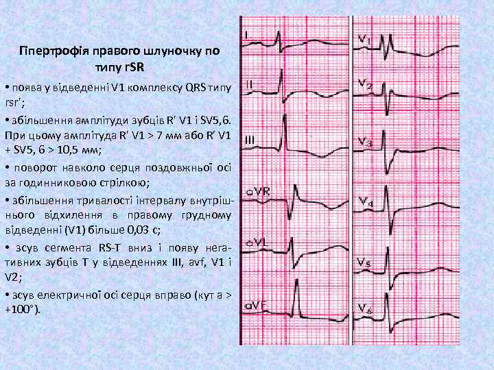 Гіпертрофія правого шлуночку по типу r. SR • поява у відведенні V 1 комплексу