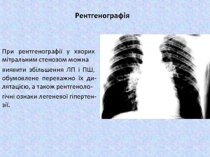 Рентгенографія При рентгенографії у хворих мітральним стенозом можна виявити збільшення ЛП і ПШ, обумовлене