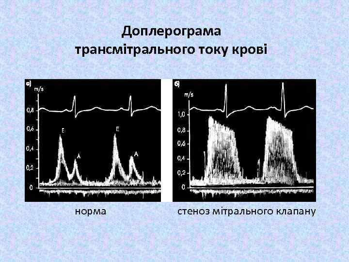 Доплерограма трансмітрального току крові норма стеноз мітрального клапану 
