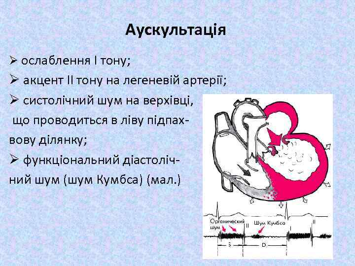 Аускультація Ø ослаблення I тону; Ø акцент ІІ тону на легеневій артерії; Ø систолічний