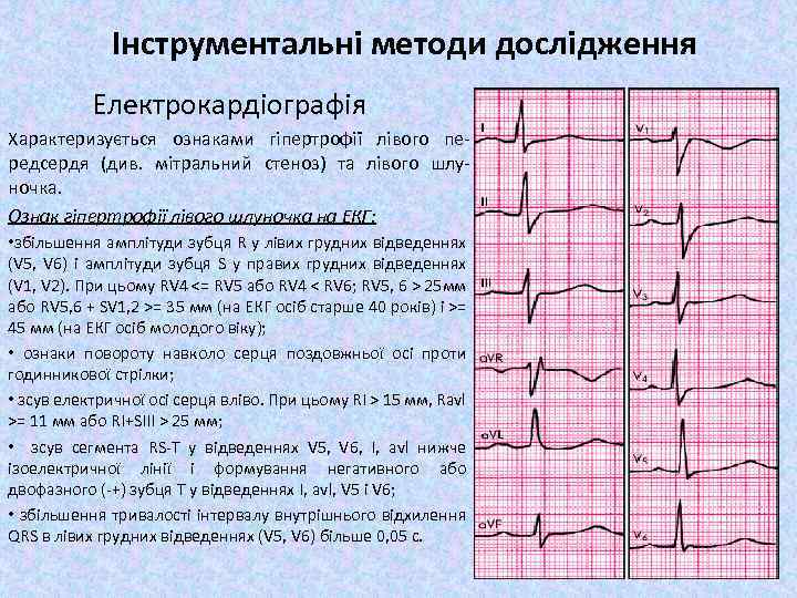 Інструментальні методи дослідження Електрокардіографія Характеризується ознаками гіпертрофії лівого передсердя (див. мітральний стеноз) та лівого