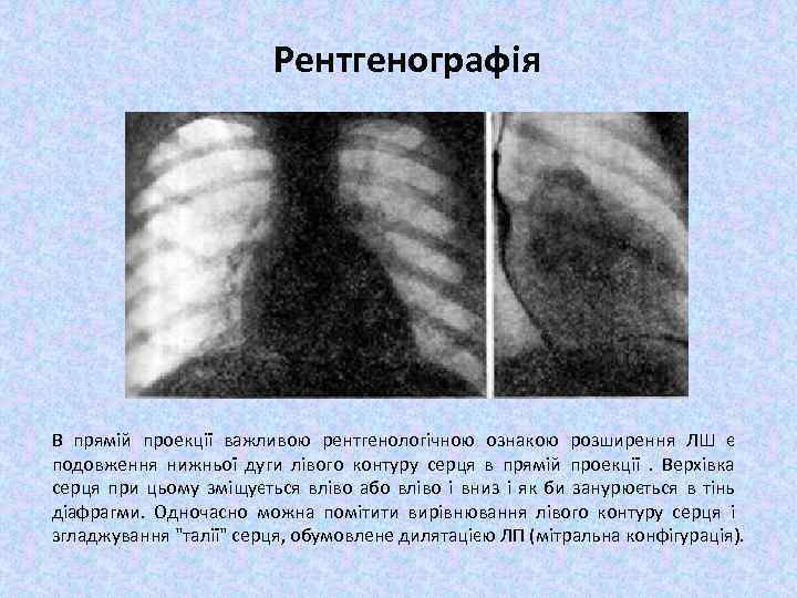 Рентгенографія В прямій проекції важливою рентгенологічною ознакою розширення ЛШ є подовження нижньої дуги лівого