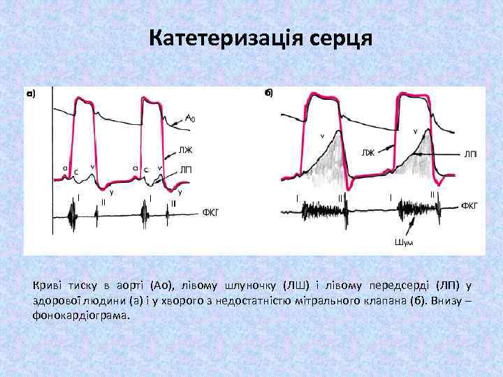 Катетеризація серця Криві тиску в аорті (Ао), лівому шлуночку (ЛШ) і лівому передсерді (ЛП)