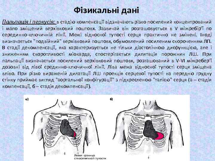 Фізикальні дані Пальпація і перкусія: в стадію компенсації відзначають різко посилений концентрований і мало