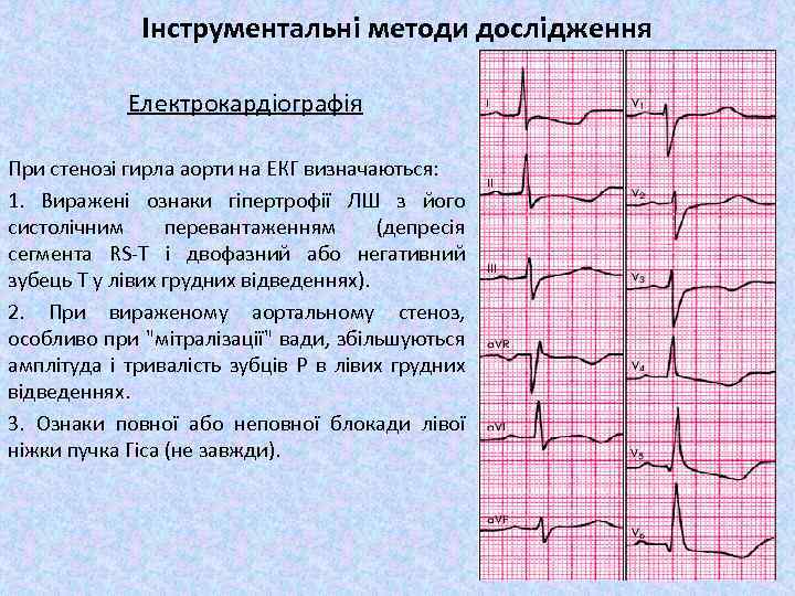 Інструментальні методи дослідження Електрокардіографія При стенозі гирла аорти на ЕКГ визначаються: 1. Виражені ознаки