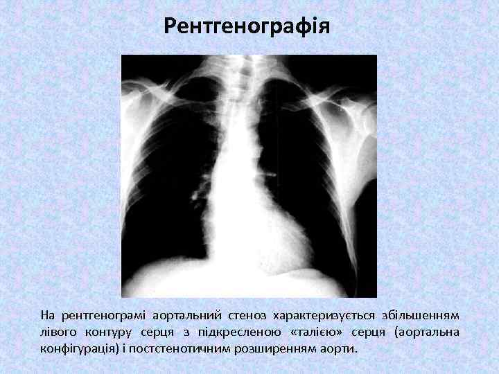 Рентгенографія На рентгенограмі аортальний стеноз характеризується збільшенням лівого контуру серця з підкресленою «талією» серця