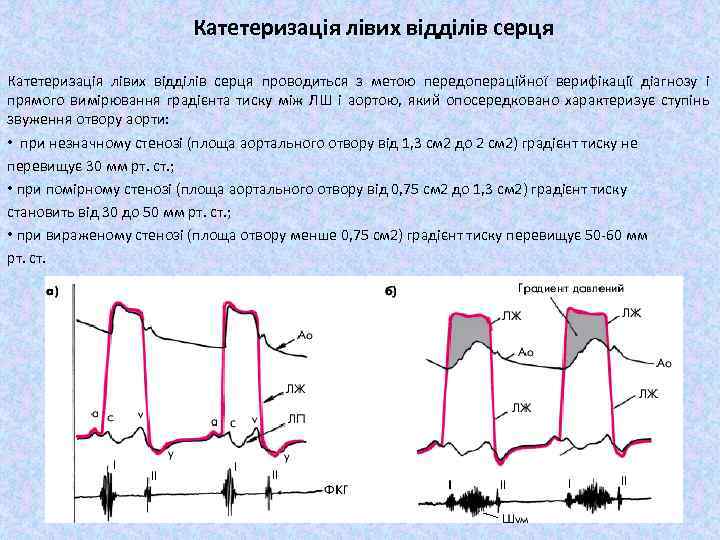 Катетеризація лівих відділів серця проводиться з метою передопераційної верифікації діагнозу і прямого вимірювання градієнта
