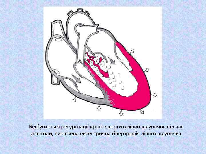 Відбувається регургітації крові з аорти в лівий шлуночок під час діастоли, виражена ексентрична гіпертрофія