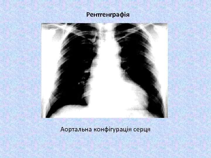 Рентгенграфія Аортальна конфігурація серця 