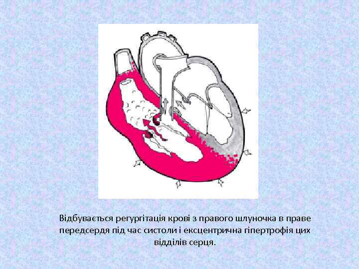 Відбувається регургітація крові з правого шлуночка в праве передсердя під час систоли і ексцентрична