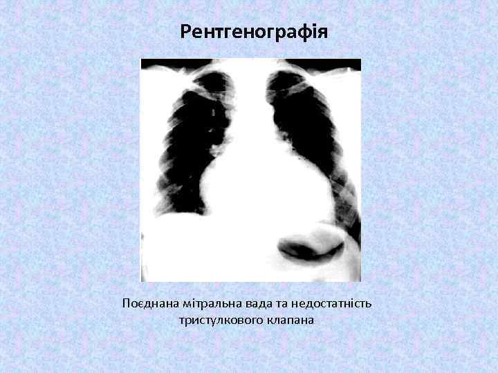 Рентгенографія Поєднана мітральна вада та недостатність тристулкового клапана 