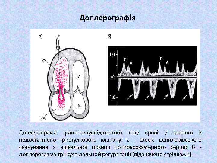 Доплерографія Доплерограма транстрикуспідального току крові у хворого з недостатністю тристулкового клапану: а - схема