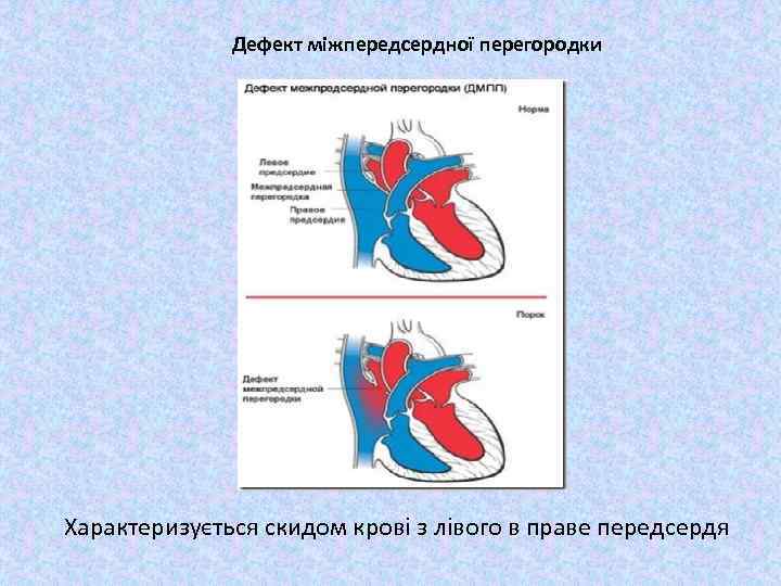 Дефект міжпередсердної перегородки Характеризується скидом крові з лівого в праве передсердя 