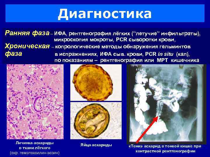 Диагностика Ранняя фаза – ИФА, рентгенография лёгких (“летучие” инфильтраты), Хроническая фаза микроскопия мокроты, PCR