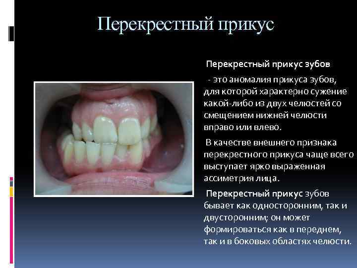 Перекрестный прикус зубов - это аномалия прикуса зубов, для которой характерно сужение какой-либо из