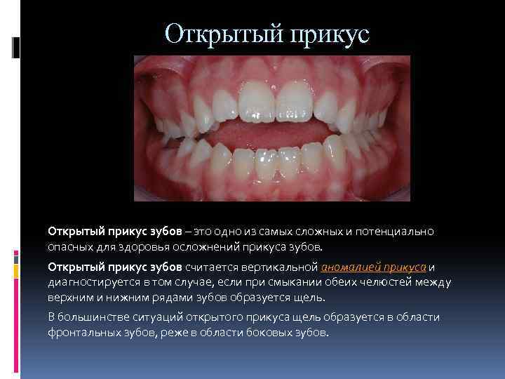 Открытый прикус зубов – это одно из самых сложных и потенциально опасных для здоровья