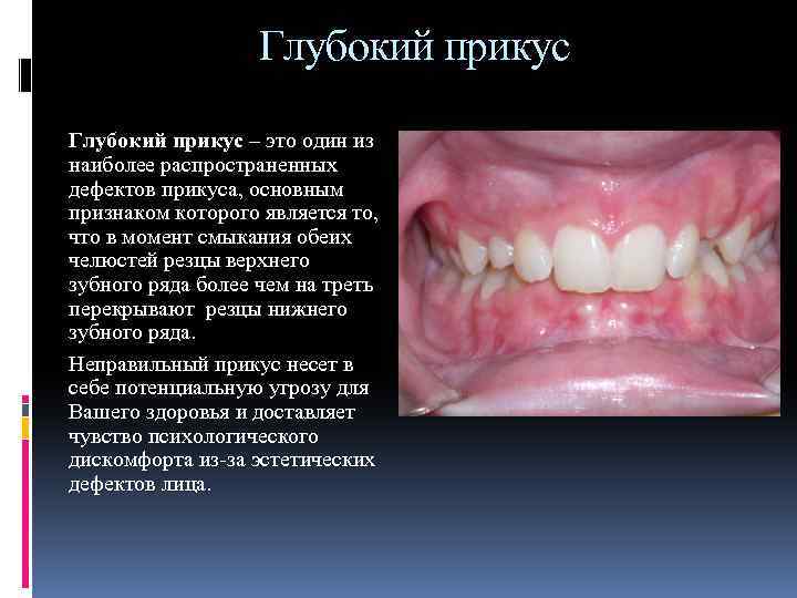 Глубокий прикус – это один из наиболее распространенных дефектов прикуса, основным признаком которого является