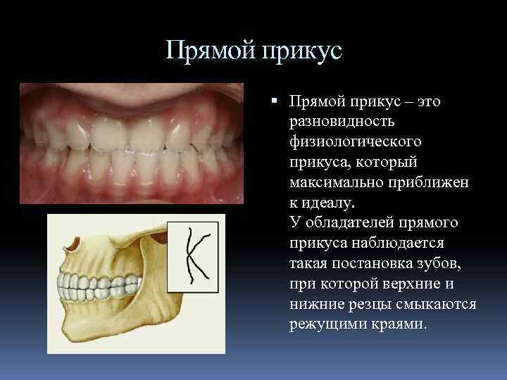 Прямой прикус – это разновидность физиологического прикуса, который максимально приближен к идеалу. У обладателей