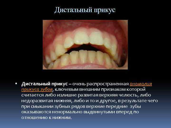 Дистальный прикус – очень распространенная аномалия прикуса зубов, ключевым внешним признаком которой считается либо